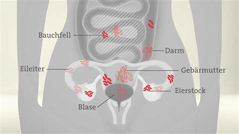 endometriose im alter